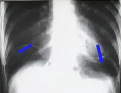 胃穿孔X线照片图片