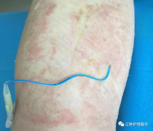敷料还在过敏看看这篇picc引起皮肤损伤的处理方法
