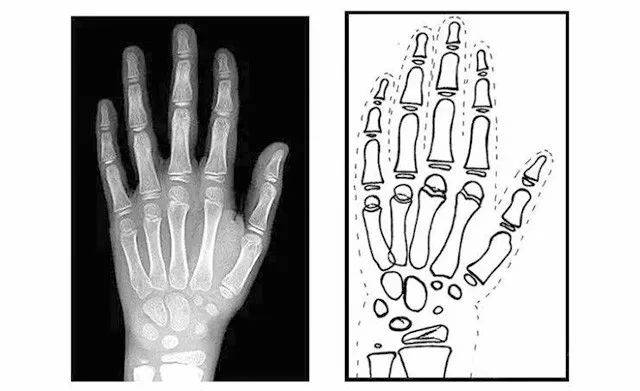 儿童手部骨骼的成长图片