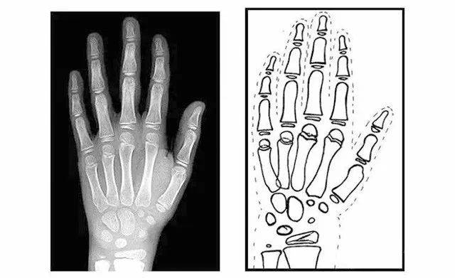 儿童手部骨骼发育图图片