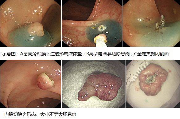 健康|大腸息肉知多少?