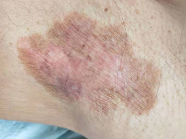 胳肢窝下湿疹变癌症 这些部位的 湿疹 要当心 可能是癌 腋窝湿疹图片 人社网