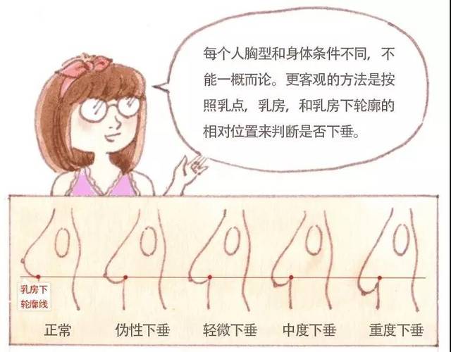 但医学界定的胸下垂:把乳点(即乳头)水平位置低于乳房下轮廓线