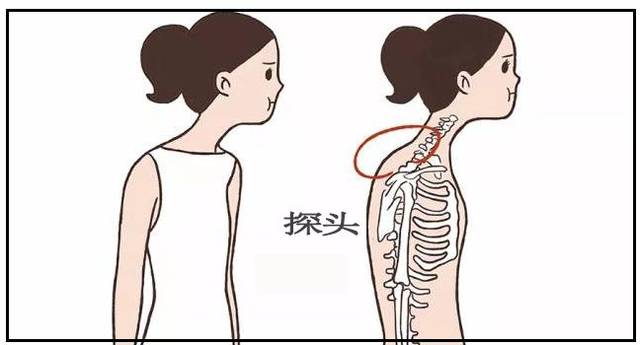 一招矫正含胸驼背,让你挺胸抬头,走路带风