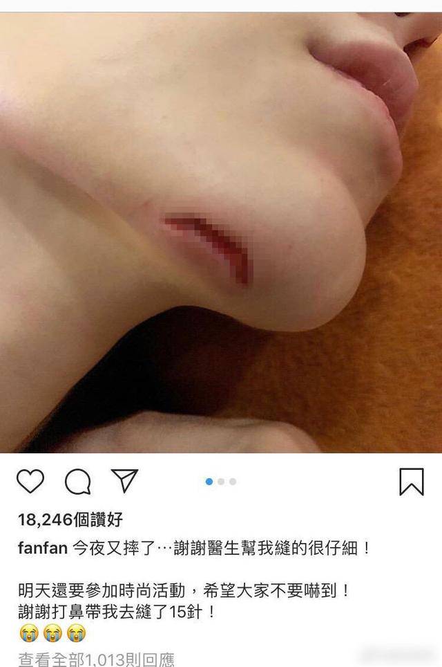 范玮琪脸受伤缝15针网友称她是博取同情你觉得呢