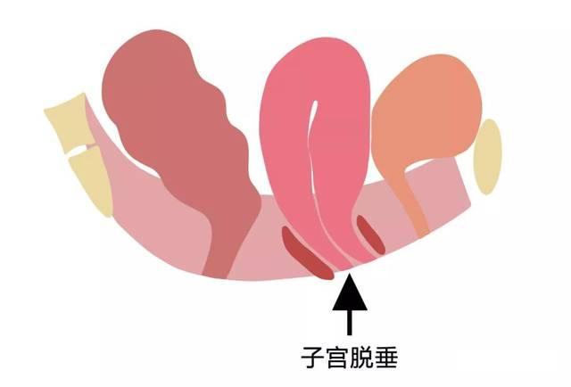 生完孩子她在阴道口摸到了一坨肉