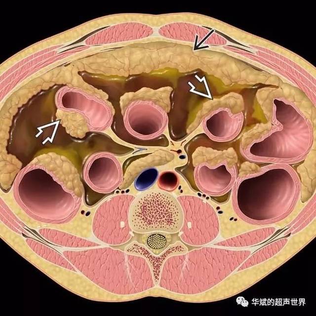 "网膜饼"(omental cake)是ct和mri成像上用来描述大网膜增厚的一个
