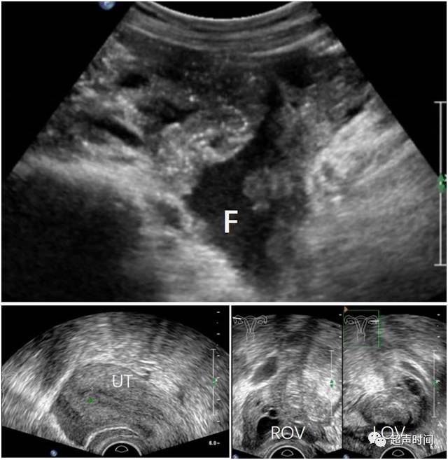 上腹部疼痛,但超声只发现盆腔积液,怎么考虑?