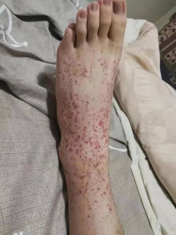 肾型紫癜:病例266例(去掉34例中断治疗者),治疗6-18个月,治愈率50%