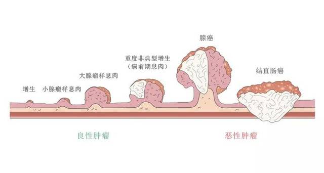 一秒读懂:什么是结直肠癌?