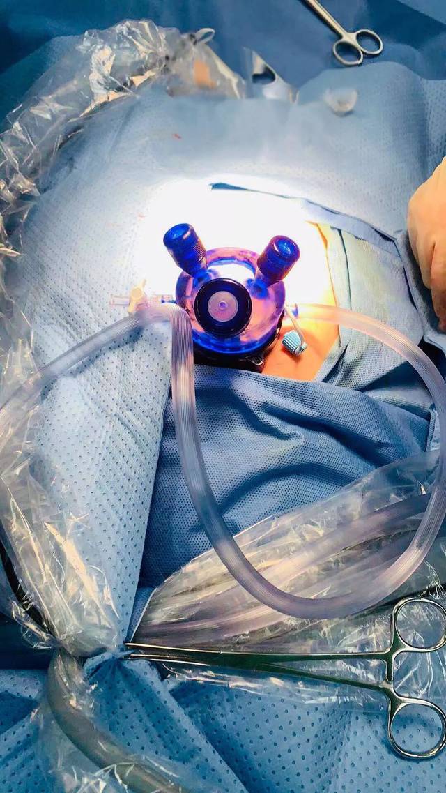 988医院东区妇产科开展单孔腹腔镜