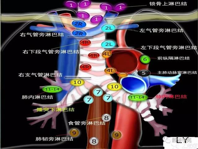 肺癌縱隔淋巴結分區