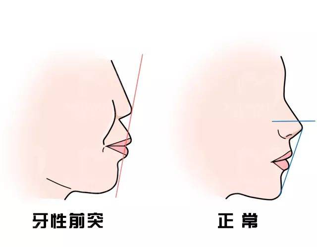 骨性双颌前突图片图片