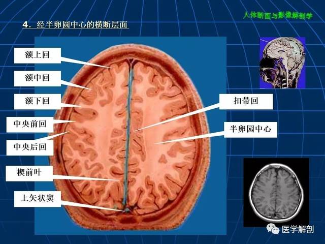 超讚!顱腦大體及磁共振斷層解剖(軸位)