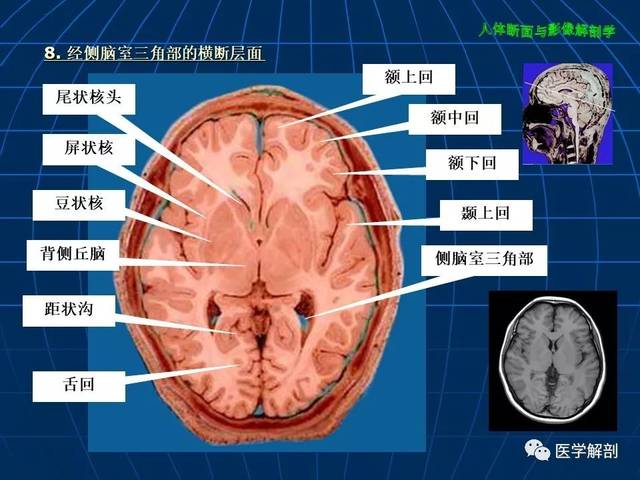 超讚!顱腦大體及磁共振斷層解剖(軸位)