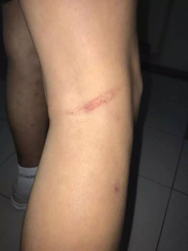 新加坡鞭刑后疤痕图片