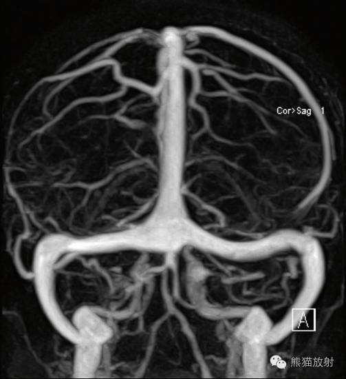 头颅静脉解剖图mrv图片