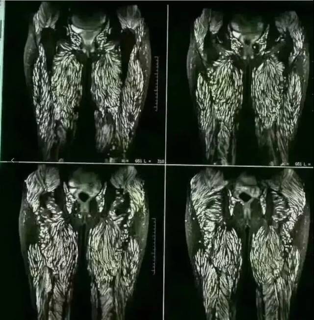 广东女子大腿小腿阴道里长满虫子全是因为吃了它很多人都爱吃