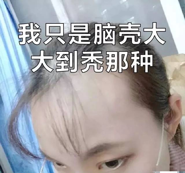 女人秃起来,比男人厉害多了!