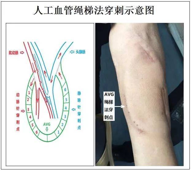 了】自體血管耗竭患者的