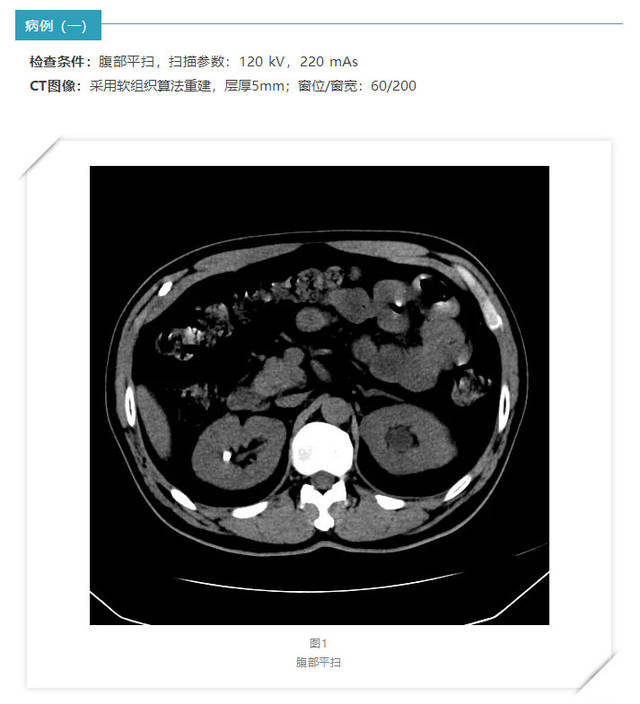 腹部肿瘤的ct检查技术