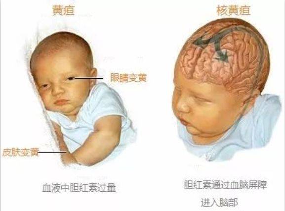 新生儿黄疸到全身水泡,只因为奶奶的土办法!