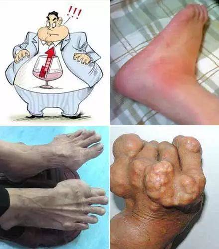 惊关节骨头竟被痛风石吃了