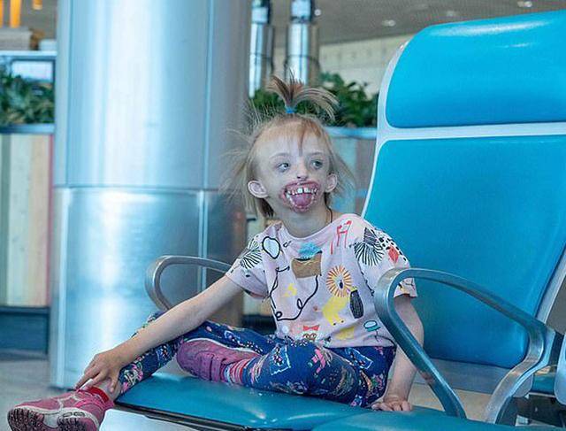 6岁女孩天生没有嘴唇下巴,亲戚太"害怕"拒绝来往_手机搜狐网