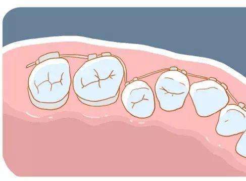 深圳專業牙醫表示,牙齒矯正主要依靠在口腔內部或外部戴用矯治器,對