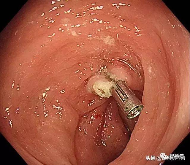 直肠息肉真实图片图片