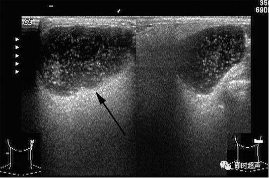 腮腺混合瘤彩超图片图片