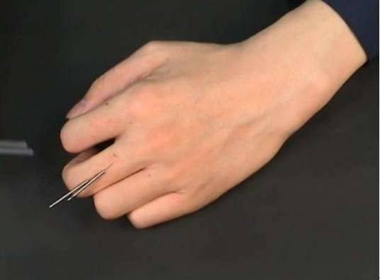 董氏奇穴-放血治病一览表 -立竿见影,超级实用