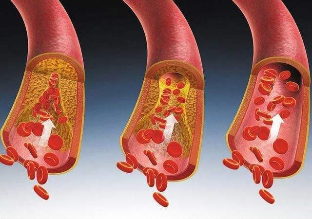 教你2个办法,让血管内的"斑块"轻松消除,或许血液会感谢你_手机搜狐网
