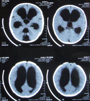 新生儿头颅ct正常图片图片