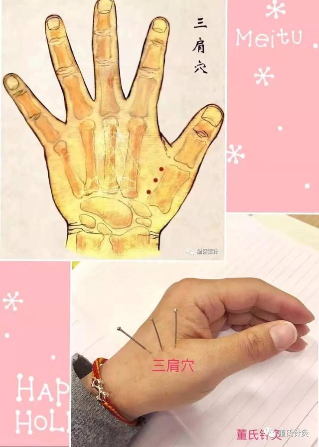 董氏针灸林正泰微课堂案例分享之三肩穴!