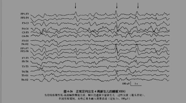 脑电图地震波图片