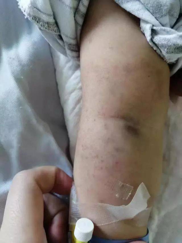 双上肢,胸腹部,后背部皮肤可见散在针尖样出血点及瘀斑,未高出皮面,压