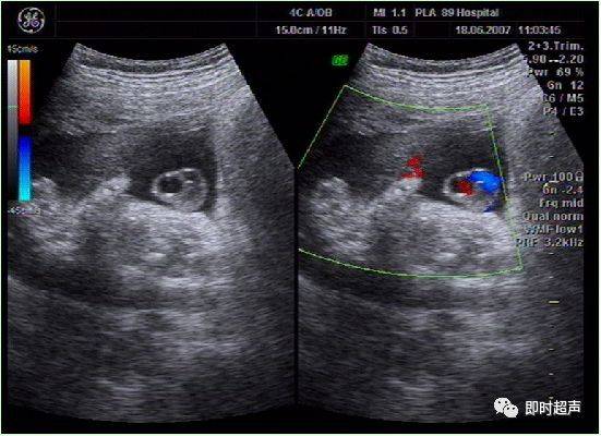 单脐动脉胎儿结构畸形妊娠结局与染色体关系