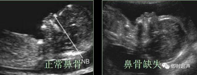 鼻骨发育不良 nb筛查时间:11—14周,异常标准:鼻骨缺失,鼻骨短小是