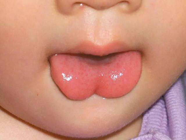 舌苔有这4种表现,说明宝宝有这样的问题!