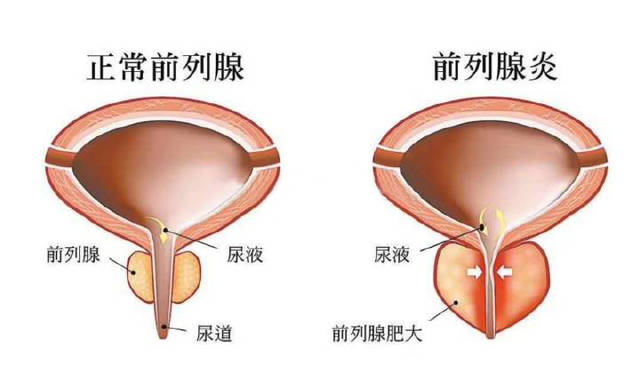 深圳金時代生物技術的幹細胞治療男性前列腺炎的最新進展