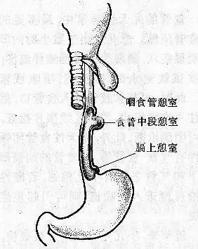 浸潤壓迫造成腺體堵塞,擴張形成囊袋,多繼發於食管痙攣,胃食管反流