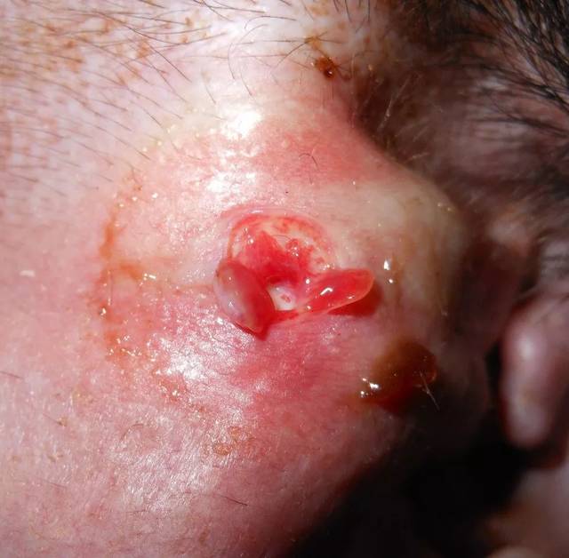 图8,糜烂.糜烂是表皮层的不完全消失,但是不会穿透表皮-真皮的交界处.