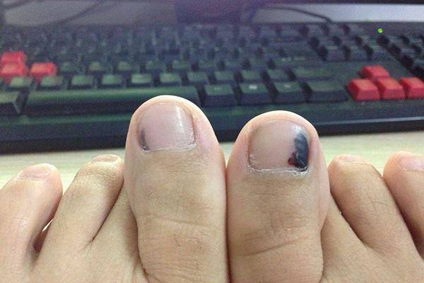 身体有癌指甲先知提醒若指甲有这个表现警惕这种癌症已到来