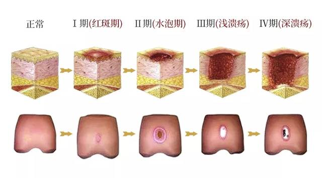 根据局部组织损伤的程度,褥疮可分为Ⅰ度(淤血红润期),Ⅱ度(炎性浸润