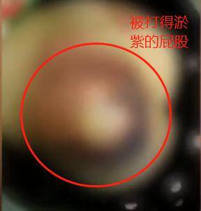 6岁女孩因作业反复出错,屁股被老师打到发紫,老师:情绪失控