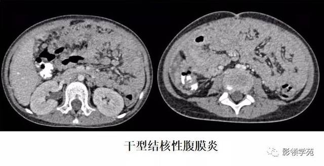 肠系膜硬化性脂膜炎图片