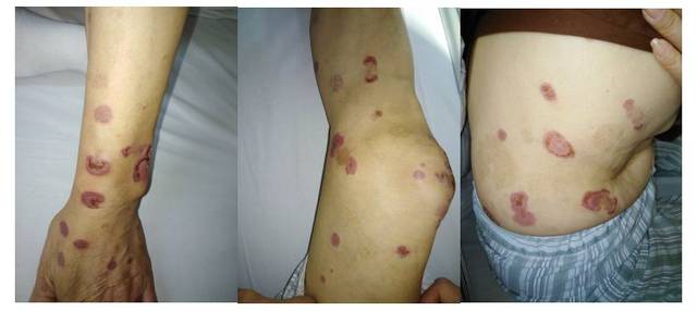 除了典型的口腔溃疡,白塞病的这个症状也不能忽视!_手机搜狐网