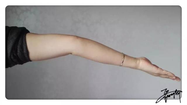 膝关节超伸超过10°(1分)