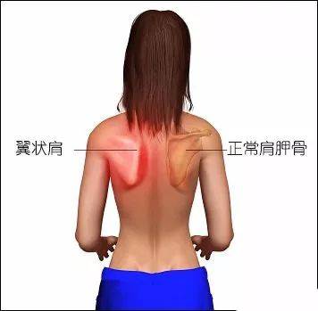 蝴蝶骨/翼状肩,手支撑肩胛骨突起?这组肌群尤其要注意啦!